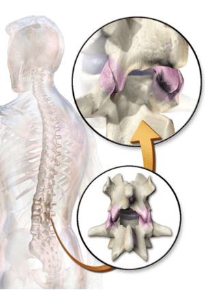 CPT Coding for Paravertebral Facet Joint Injections – the Impact